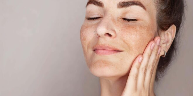 Sun Exposure in Hyperpigmentation