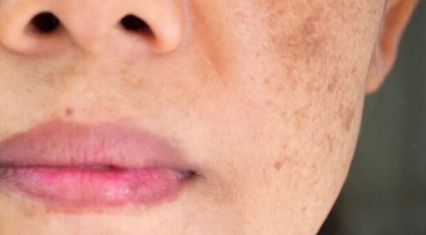 What Is Melasma